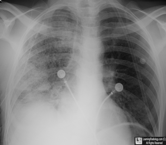 Re-expansion Pulmonary Edema